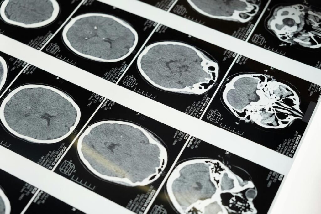 LCT o conmoción cerebral no tratada