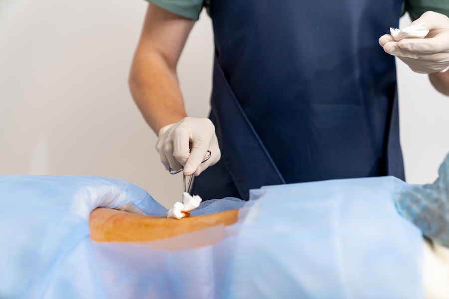 Laparoscopic Surgery Error Malpractice